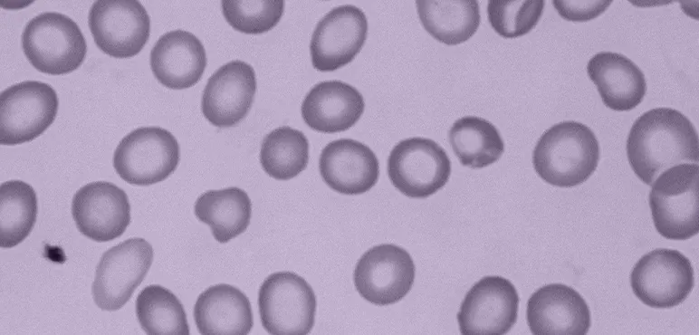 Iron deficiency anemia shown in red blood cells at 400X. Due to lesser amounts of haemoglobin, the cells have an abnormally large central pallor